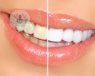 blanquear dientes
