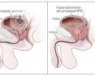 La Hipertrofia Benigna de Próstata (HBP) está causada por alteraciones de tamaño en la próstata debido a cambios hormonales propios del paso de los años. El Dr. López informa