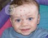 Niño con la enfermedad contagiosa varicela