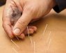 acupuntura tratamiento dolor
