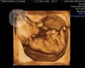 gastrosquisis fetal bebé