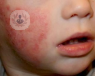La dermatitis atópica es frecuente en niños, pero puede aliviarse.