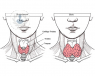bocio multinodular glandula tiroides