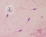 Fragmentación del ADN espermatozoides