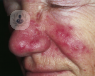 La rosácea es un problema dermatológico incómodo por su apariencia y localización facial. Descubre las innovaciones en el tratamiento de la rosácea.