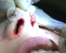 La septoplastia, cirugía de nariz, se realiza para mejorar la función respiratoria