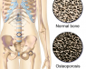 La osteoporosis puede ser primaria (por falta de estrógenos o por edad) o secundaria (consecuencia de un fármaco o enfermedad)