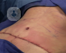 La Dra. Nélida Grande analiza la abdominoplastia o lipectomía de abdomen, operación quirúrgica para la reconstrucción del abdomen y para bajar volumen.