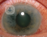 El glaucoma es una enfermedad que puede llegar a provocar ceguera