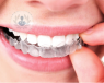 La ortodoncia invisible es un método eficaz y estético para corregir la posición de los dientes