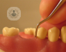 consecuencias periodontitis