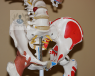 La porotesis de cadera en ocasiones requiere un reemplazo debido al dolor que produce si algo no funciona bien. Operación de recambio de prótesis en el artículo.