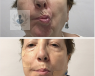 Tratamiento fisioterapéutico de la parálisis facial