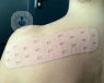 El Punch Tape es una técnica de vendaje neuromuscular que ha demostrado ser útil para tratar el linfedema 