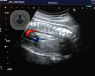 Qué es la ecocardiografía fetal