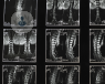 Las técnicas sobre artroscopia, endoscopia y mínimamente invasivas, las explica el Dr. Ricardo Casal en lesiones de cadera, cruzado anterior o hernia discal