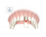 dientes con aplicación de corona dental