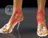 Lesiones frecuentes del pie | Top Doctors