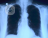 La cirugía torácica mínimamente invasiva para abordar el cáncer de pulmón permite extirparlo sin abrir al paciente