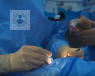 trasplante de cornea tecnicas selectivas operación oftalmologo topdoctors