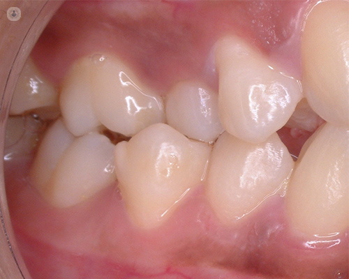 maloclusión dental