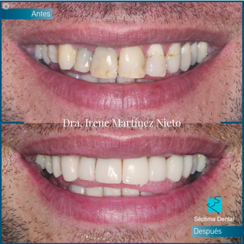 Antes y después con carillas dentales