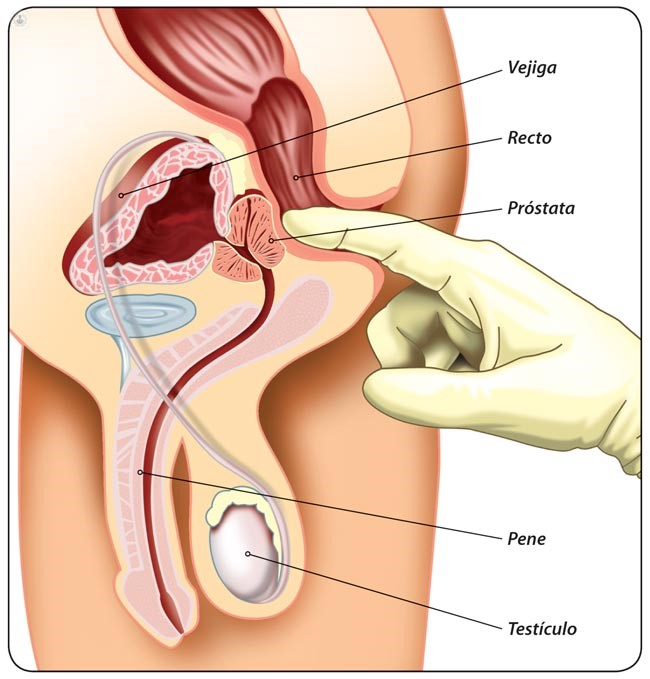 tacto rectal cáncer de próstata