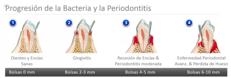Ejemplo periodontitis
