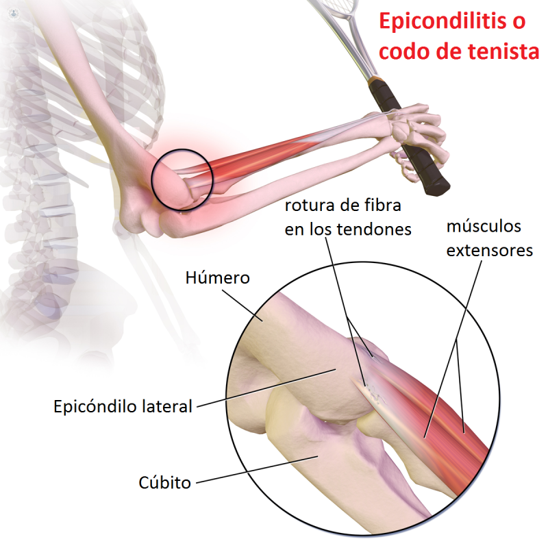 Infografía epicondilitis