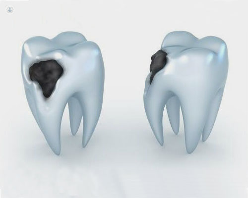 Ilustración de dientes con caries - by Top Doctors