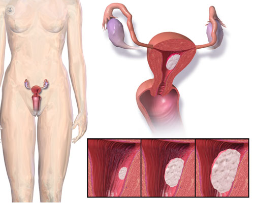 Ilustración que muestra el crecimiento y ubicación de un tumor de útero - cáncer de útero - by Top Doctors