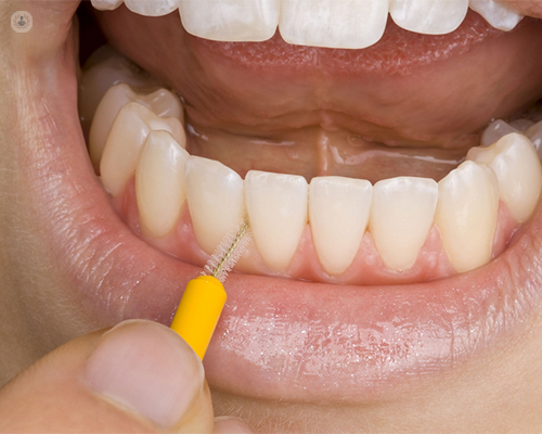 Mantener una buena higiene dental es la mejor manera de cuidar los implantes