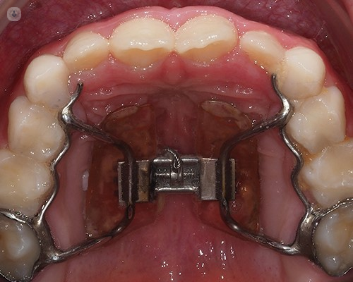 Bruxismo y ortodoncia por el Dr. Fernando de la Iglesia
