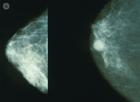 La ecografía de mama es una técnica utilizada en los últimos años en el diagnóstico del cáncer de mama. Conoce todos los detalles en este artículo.