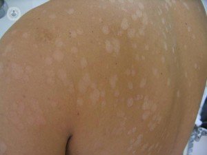 Hongos, causa de manchas la piel