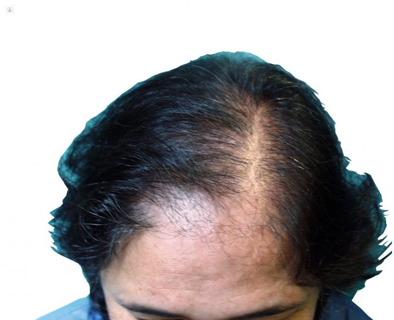 Пересадка волос