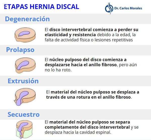 Etapas de la hernia