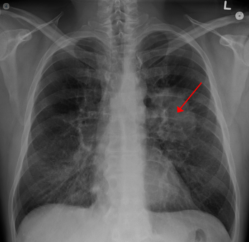 foto cancer pulmon