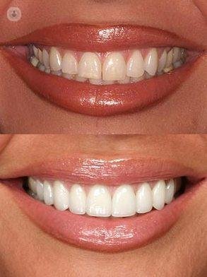 Descubre todas las ventajas de las carillas dentales de composite y de porcelana en este artículo.