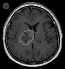 brain tumor glioblastoma