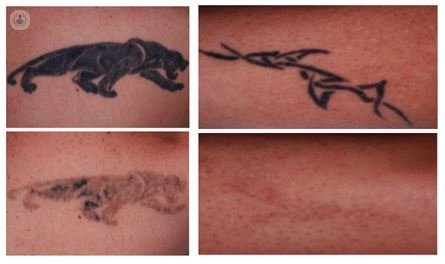 удаления татуировок