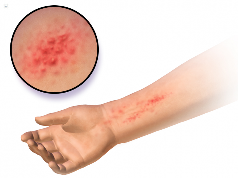 Enfermedades de la dermatitis alérgica y de contacto