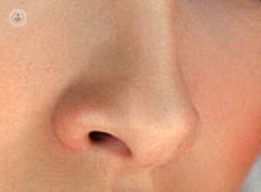 septorhinoplasty хирургия носа