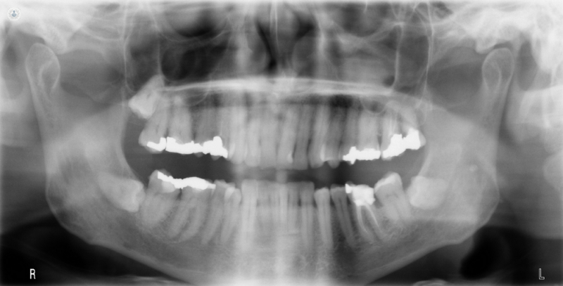El Cáncer Oral puede afectar a cualquier estructura de la cavidad bucal.