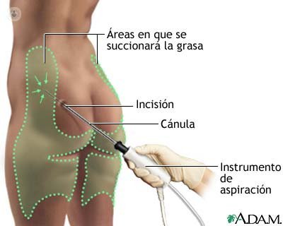 Liposuction explanation