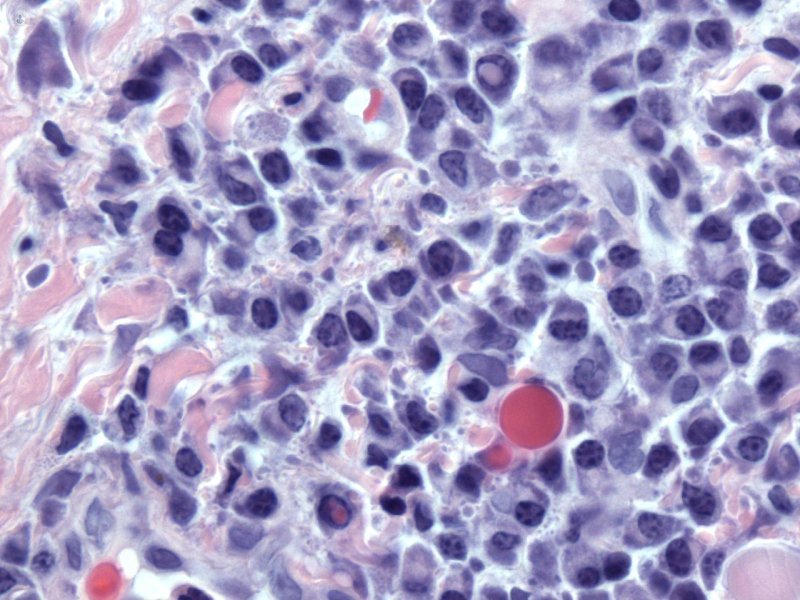 mieloma multiple columna