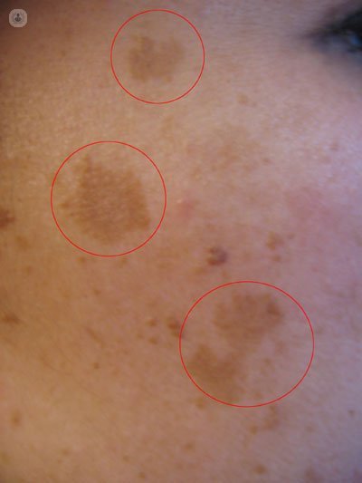 spots on the skin