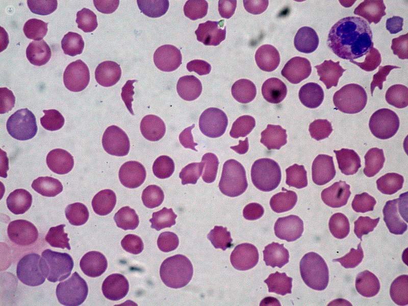 La anemia es la dificultad o disminución del transporte de oxígeno al resto de tejidos a través de los glóbulos rojos. El Dr. Alcaraz te informa. 