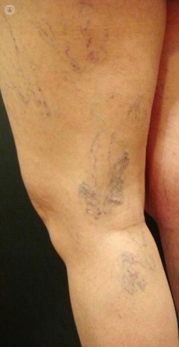 Vascular Surgery recommends this technique to remove varicose veins