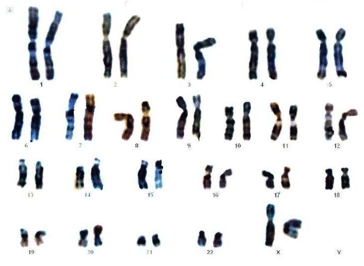genetic map preimplantation genetic diagnosis chromosomes